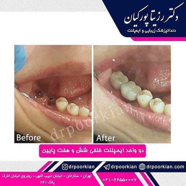 عکس قبل و بعد ایمپلنت دندان