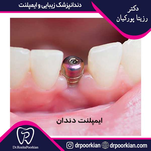 عکس ایمپلنت دندان