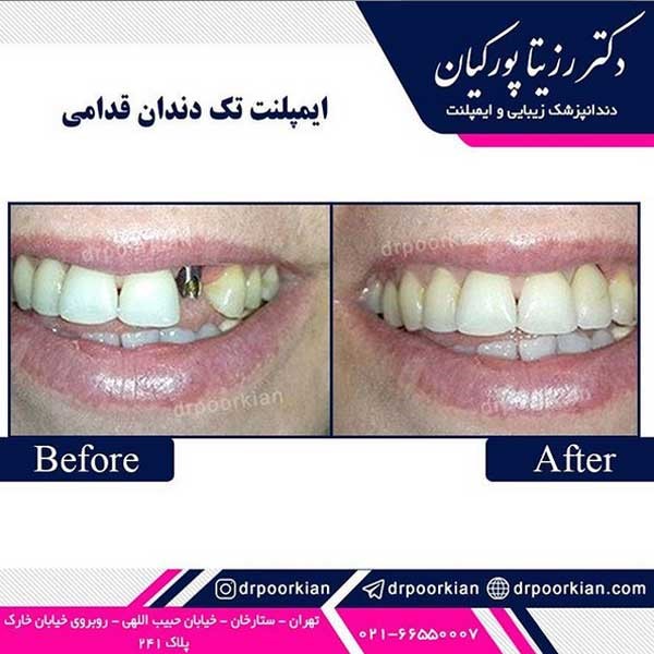 عکس ایمپلنت دندان
