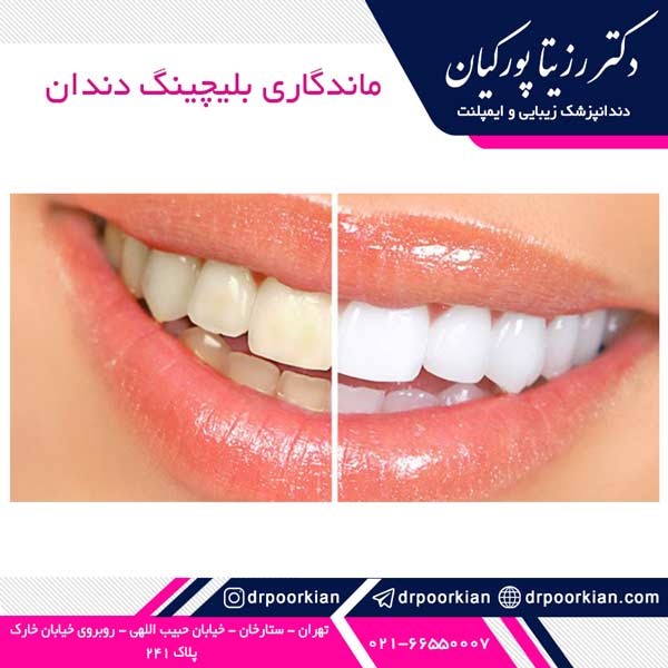 بلیچینگ دندان