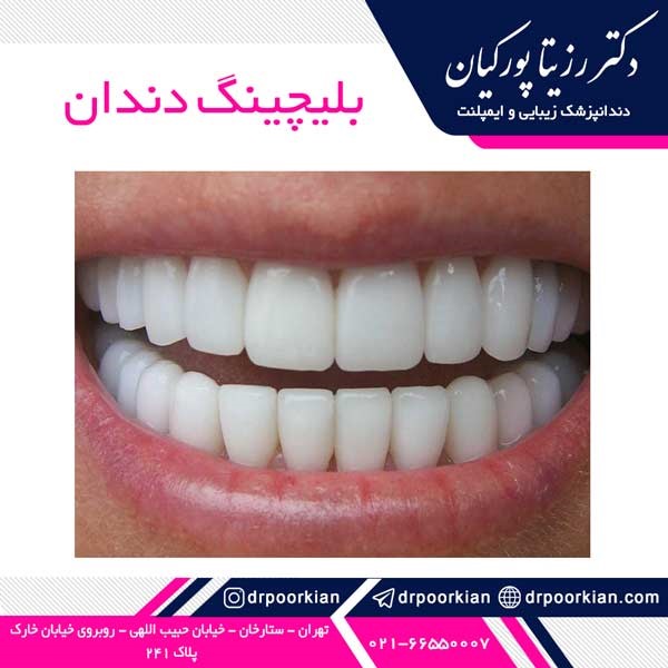 عکس بعد از بلیچینگ دندان