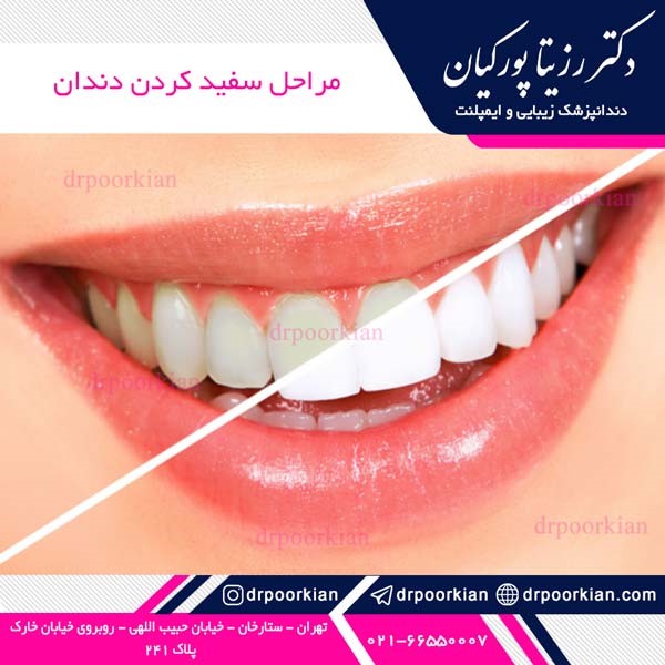 عکس سفید کردن دندان - دکتر رزیتا پورکیان