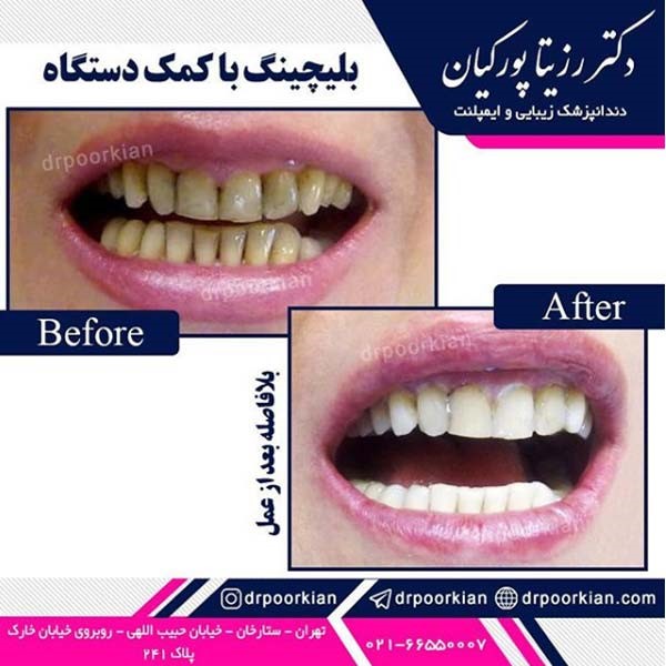 عکس قبل و بعد سفید کردن دندان - دکتر رزیتا پورکیان