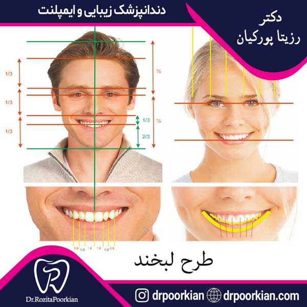 طرح لبخند قبل و بعد - دکتر رزیتا پورکیان