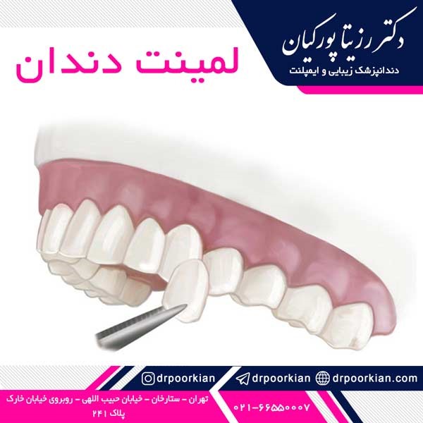 عکس لمینت دندان