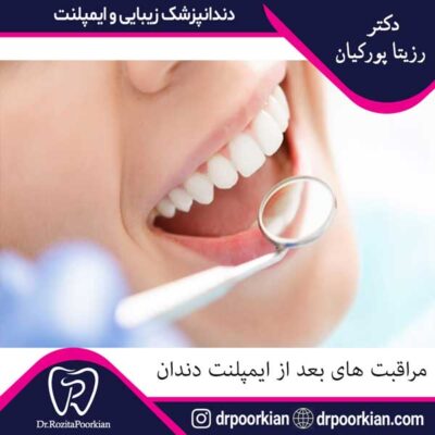مراقبت های بعد از ایمپلنت دندان - دکتر پورکیان