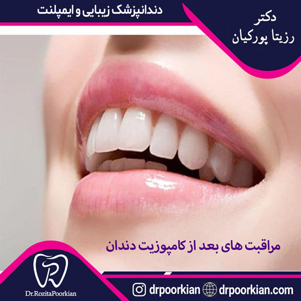 عکس مراقبت های بعد از کامپوزیت دندان