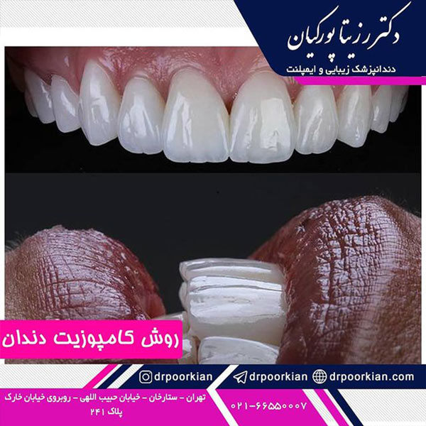عکس کامپوزیت دندان