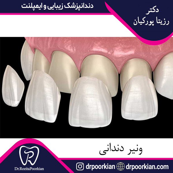 عکس ونیر دندانی