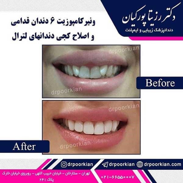 عکس قبل و بعد طرح لبخند - دکتر رزیتا پورکیان
