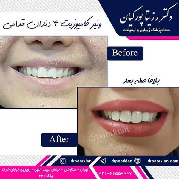 عکس قبل و بعد طرح لبخند با کامپوزیت - دکتر رزیتا پورکیان