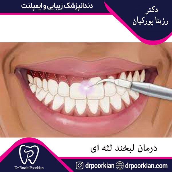 عکس لبخند لثه ای