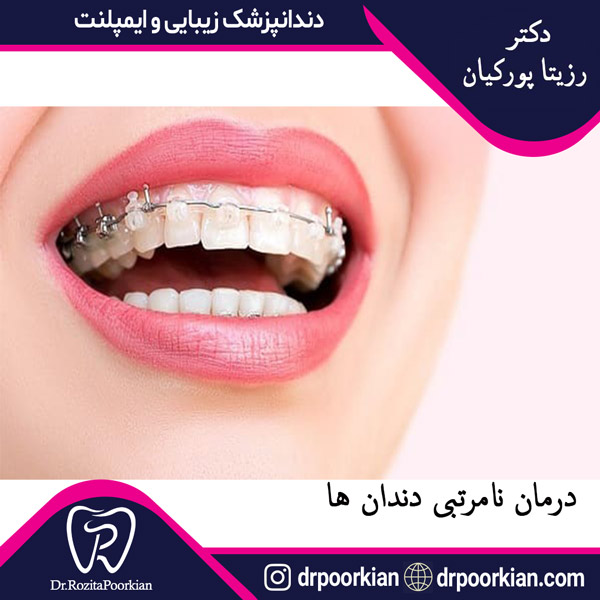 عکس ارتودنسی دندان - اصلاح نامرتبی دندان ها