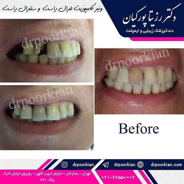 عکس ونیر کامپوزیت - بهترین داندانپزشک غرب تهران