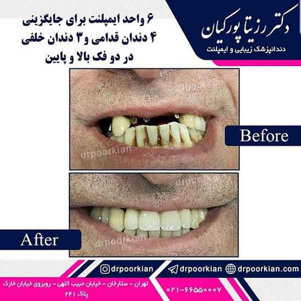 عکس قبل و بعد پروتز دندان - دکتر رزینا پورکیان