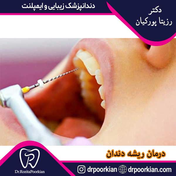 عکس درمان ریشه دندان - دکتر رزیتا پورکیان