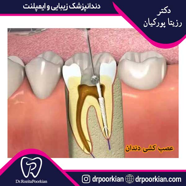 عکس درمان ریشه دندان - دکتر رزیتا پورکیان