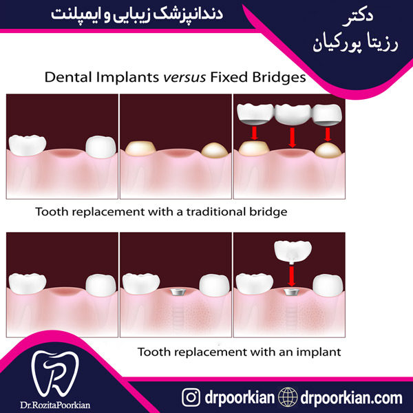عکس بریج دندان در ستارخان - دکتر پورکیان