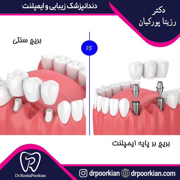 عکس بریج دندان در ستارخان - دکتر پورکیان