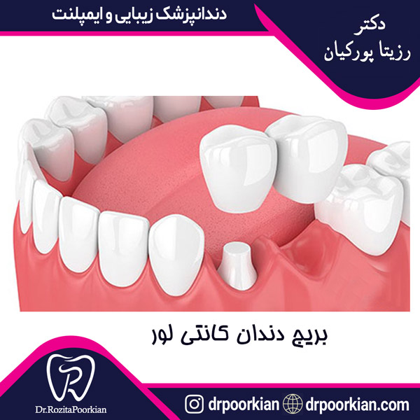 عکس بریج دندان کانتی لور در ستارخان