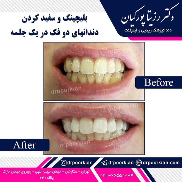 عکس قبل و بعد بلیچینگ دندان