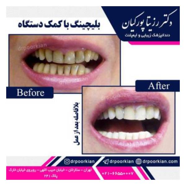 عکس قبل و بعد بلیچینگ دندان