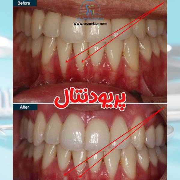 پریودنتال - دکتر رزیتا پورکیان