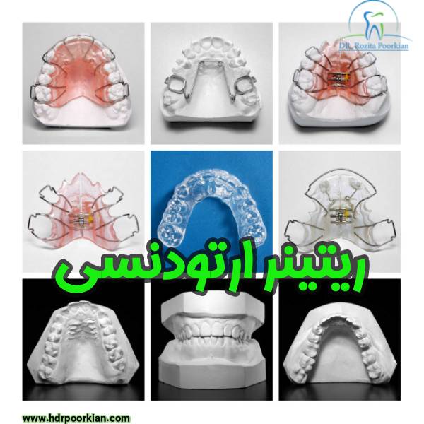 ریتینر ارتودنسی - دکتر رزیتا پورکیان