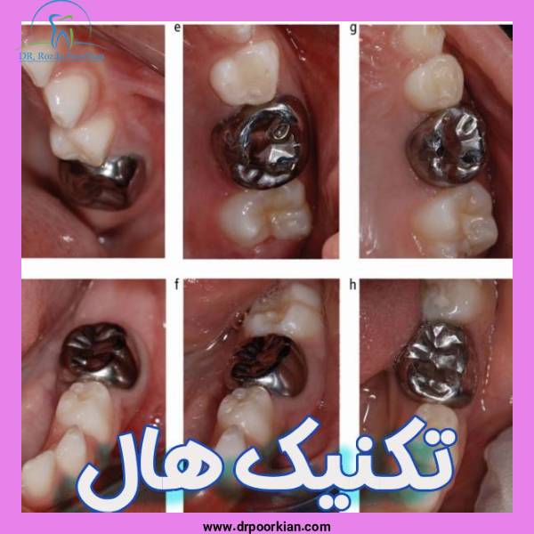 تکنیک هال - دکتر رزیتا پورکیان