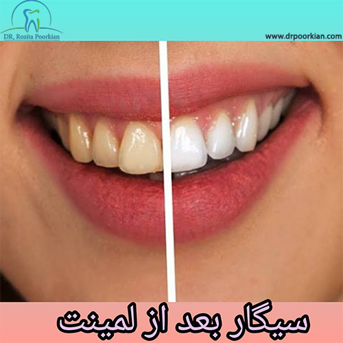 سیگار بعد از لمینت - دکتر رزیتا پورکیان