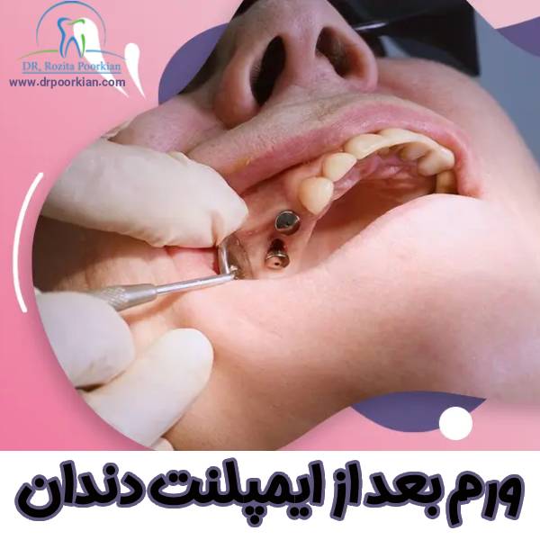 ورم بعد از ایمپلنت دندان - دکتر رزیتا پورکیان