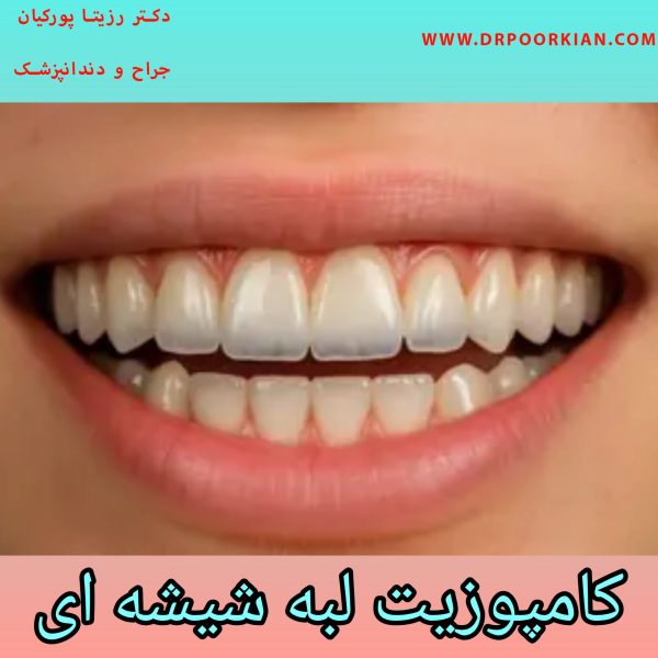 کامپوزیت لبه شیشه ای - دکتر رزیتا پورکیان